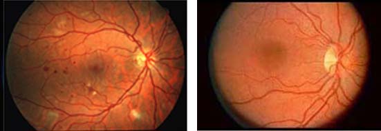רטינופטיה סוכרתית - סכרת בעין 